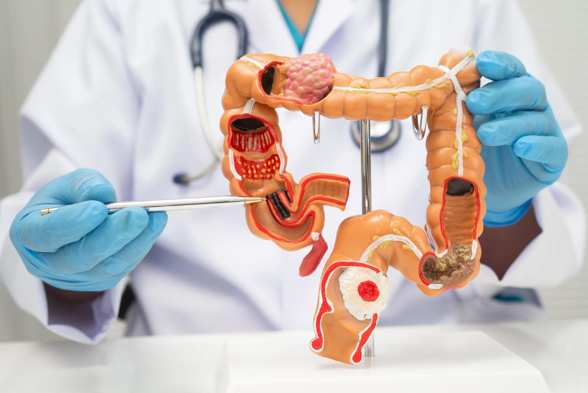 Retocolite ulcerativa: sintomas, diagnóstico, tratamento e qualidade de vida